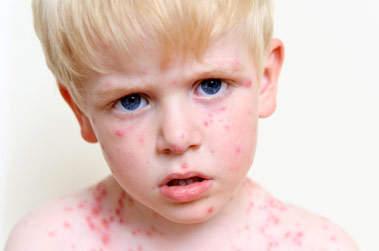Cours - Pédiatrie - Les maladies contagieuses de l'enfant ...