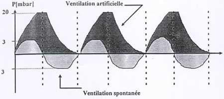 Cours - Réanimation - La ventilation artificielle | Infirmiers.com