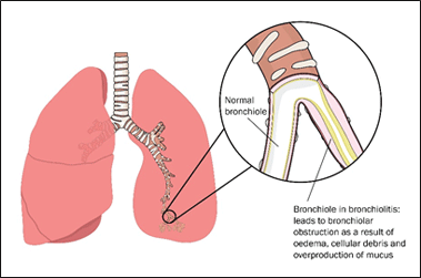 What is bronchiolitis ?