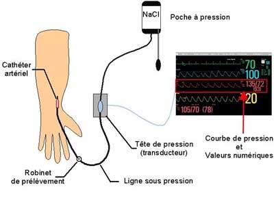 schema pression artérielle sanglante