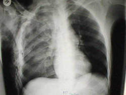 Pneumothorax G : le poumon G